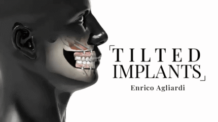 Angulated Dental Implants